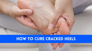 sehatnagar-how-to-cure-cracked-heels
