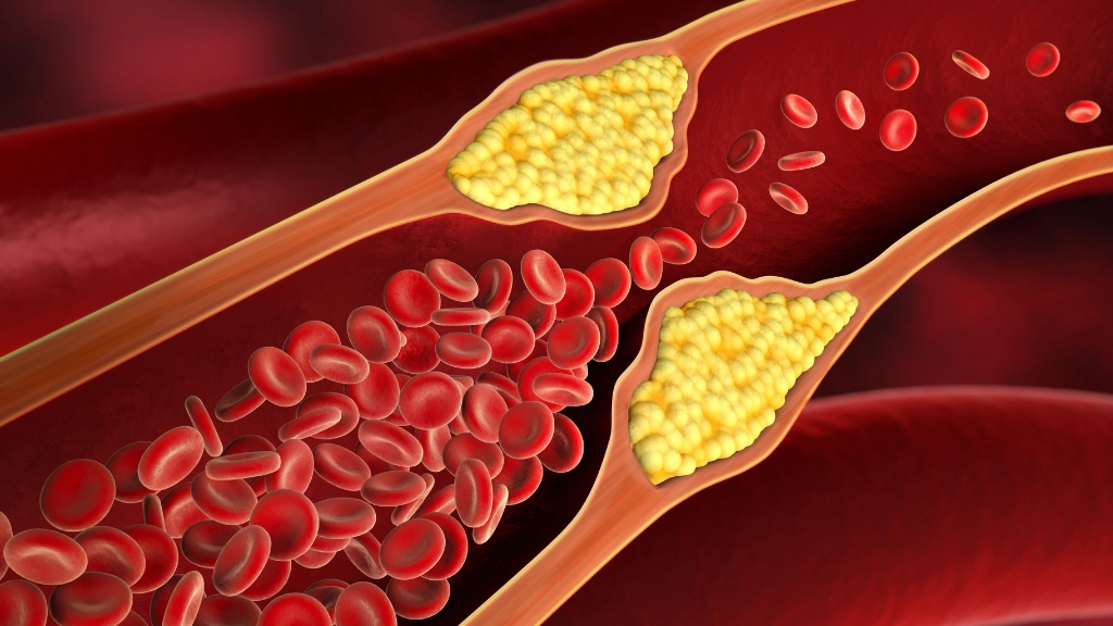 sehatnagar-high-cholesterol-tips-for-healthy-living-lifestyle