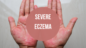 sehatnagar-severe-eczema-tips-for-healthy-living-lifestyle