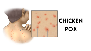 chicken-pox-blisters