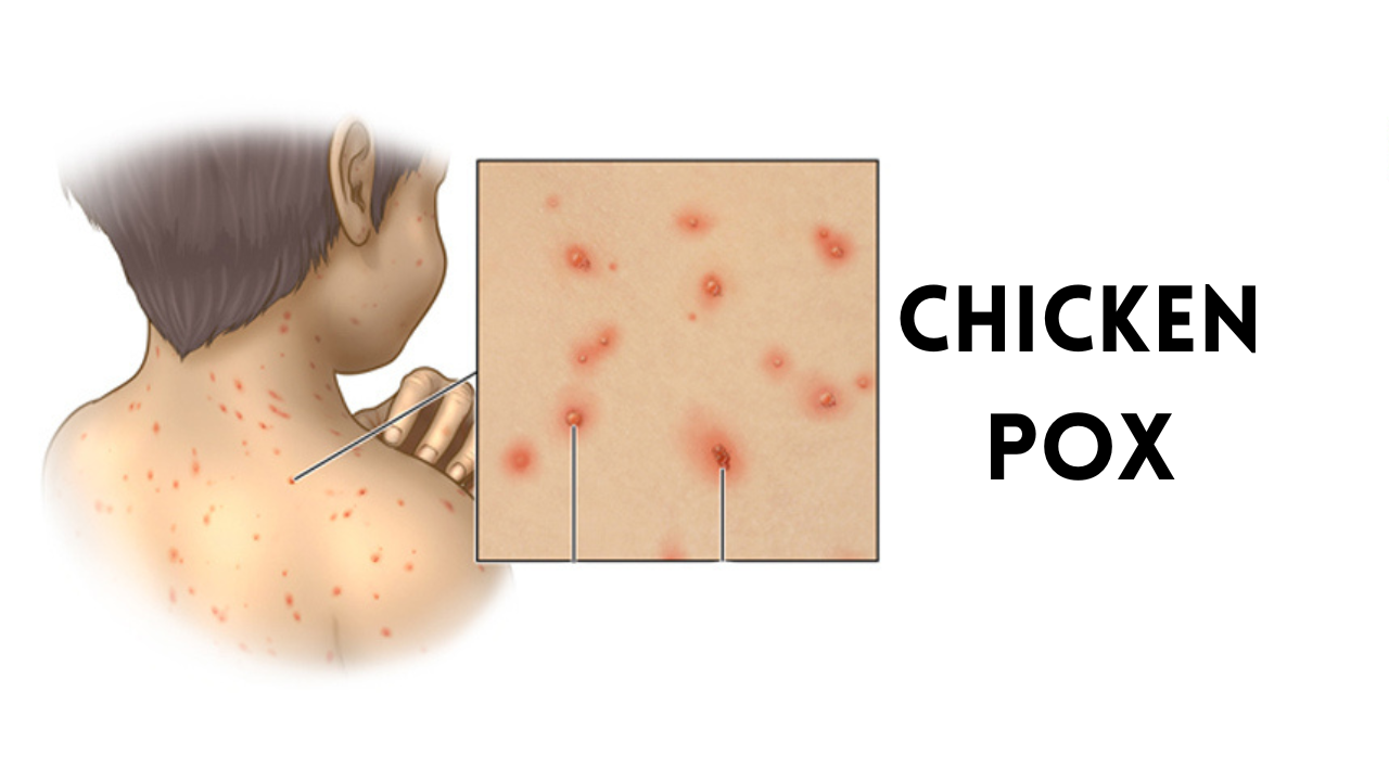 Chicken Pox Blisters: Major Signs, Causes & Risk Elements