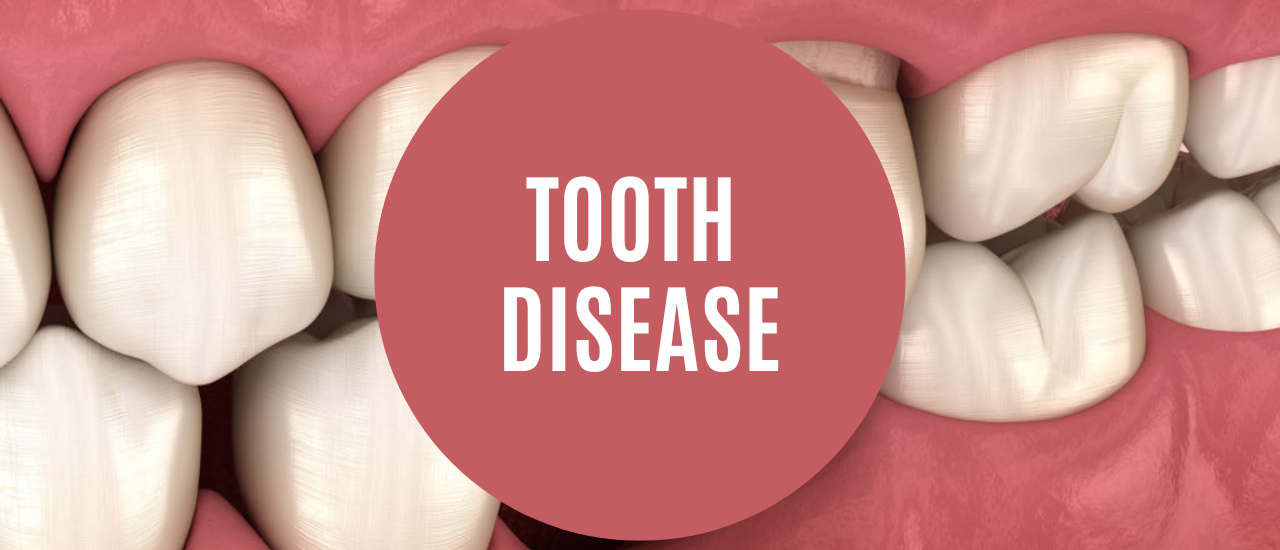 sehatnagar-tooth-disease-tips-for-healthy-living-lifestyle