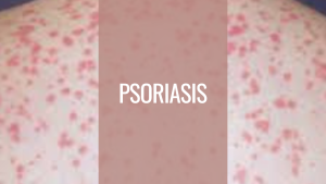 sehatnagar-psoriasis-disease-tips-for-healthy-living-lifestyle