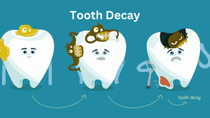 sehatnagar-tooth-decay-tips-for-healthy living-lifestyle
