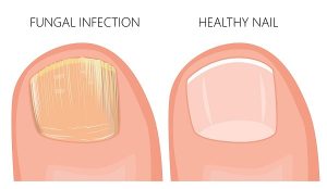 sehatnagar-fingernail-and-toenail-fungus-tips-for-healthy-living-lifestyle