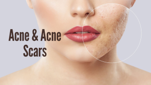 sehatnagar-acne-and-acne-scars-tips-for-healthy-living-lifestyle