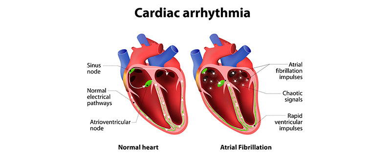 Arrhythmia-symptoms
