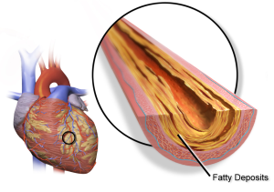 Coronary-artery-disease-sehatnagar-com