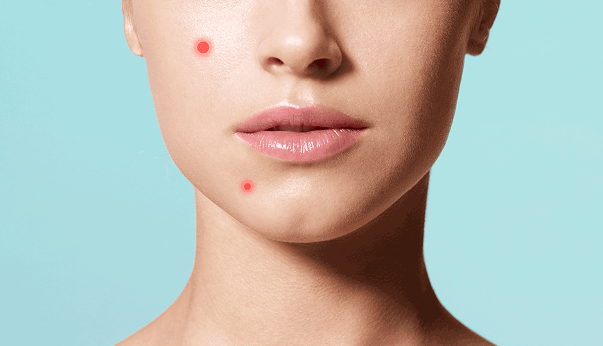 Pimple Face Images- Pimple problems - sehatnagar-com