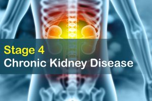 Stage 4 of Chronic Kidney Disease