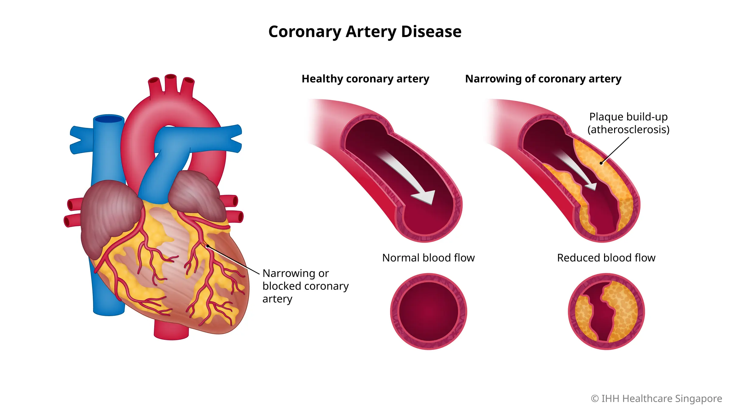 causes-and-symptoms-of-Coronary-artery-disease-sehatnagar-com