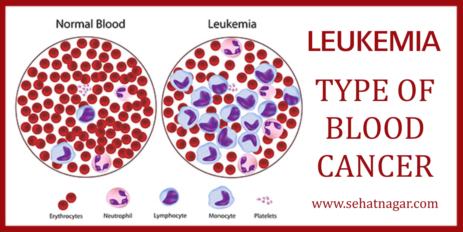 leukemia-type-of-blood-cancer-sehatnagar-com