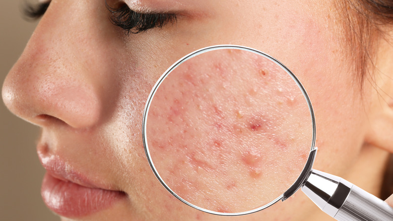 Pimple-dark-spots-sehatnagar-com