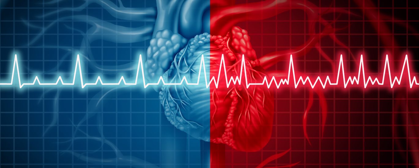 Arrhythmia overview, causes, symptoms, diagnosis, treatment and lifestyle
