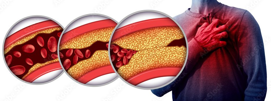Levels-of-Cholesterol-causes-symptoms-and-treatment