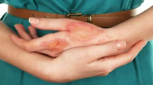 burn-scars-causes-treatment-prevention