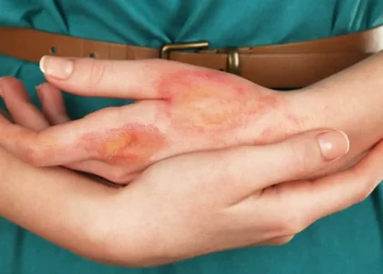 burn-scars-causes-treatment-prevention
