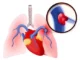 how-long-before-a-pulmonary-embolism-kills-you