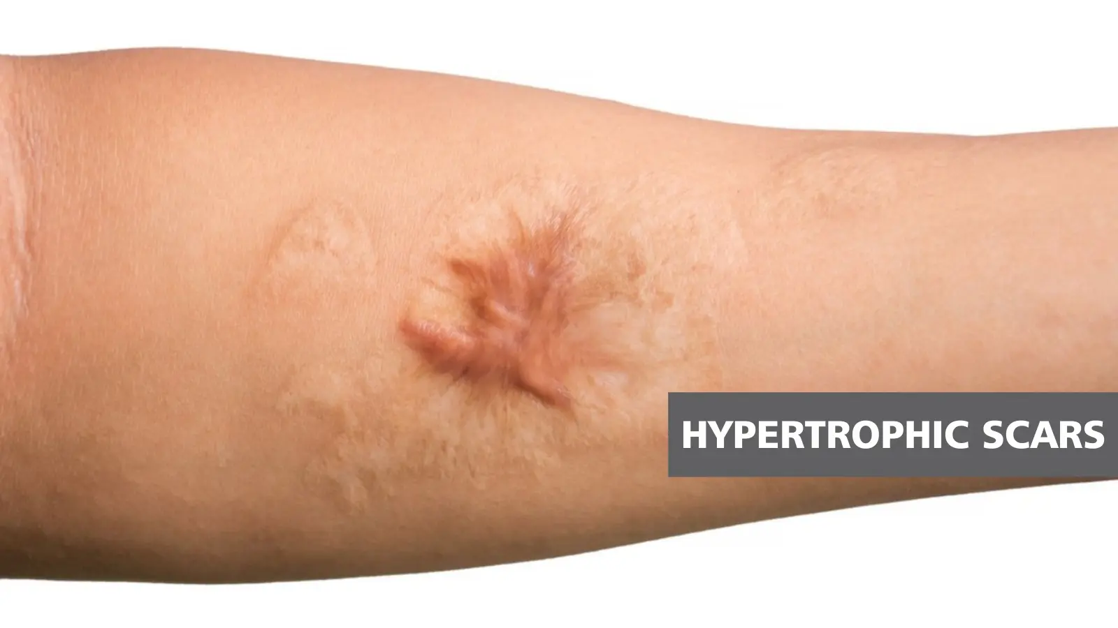 hypertrophic-scars-sehatnagar-com