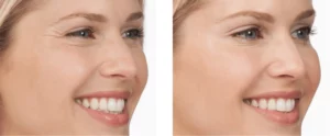 botox-before-and-after-crows-feet-sehatnagar