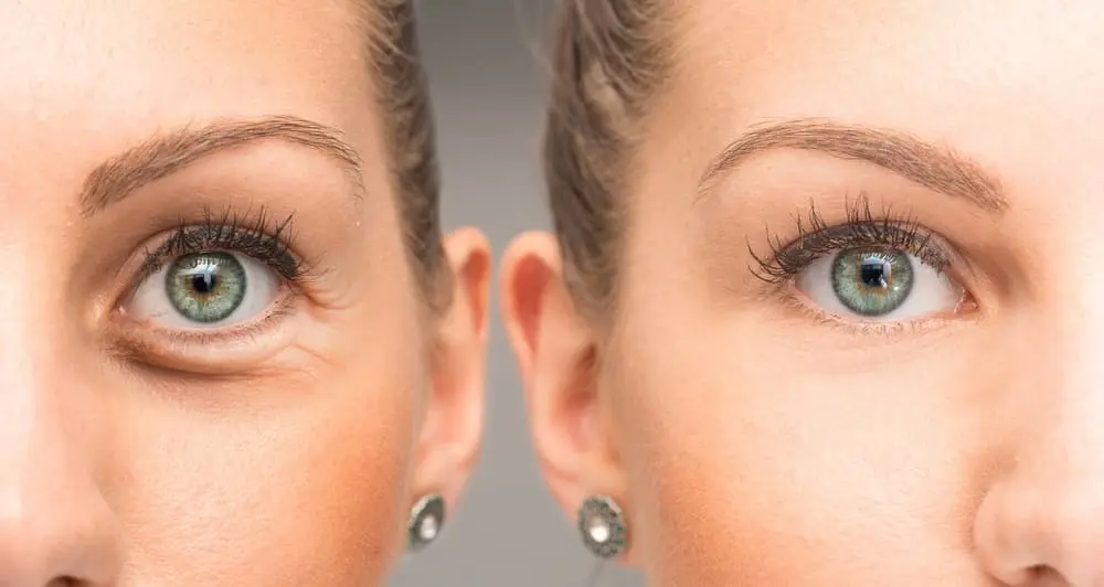 botox-before-and-after-crows-feet-sehatnagar-com