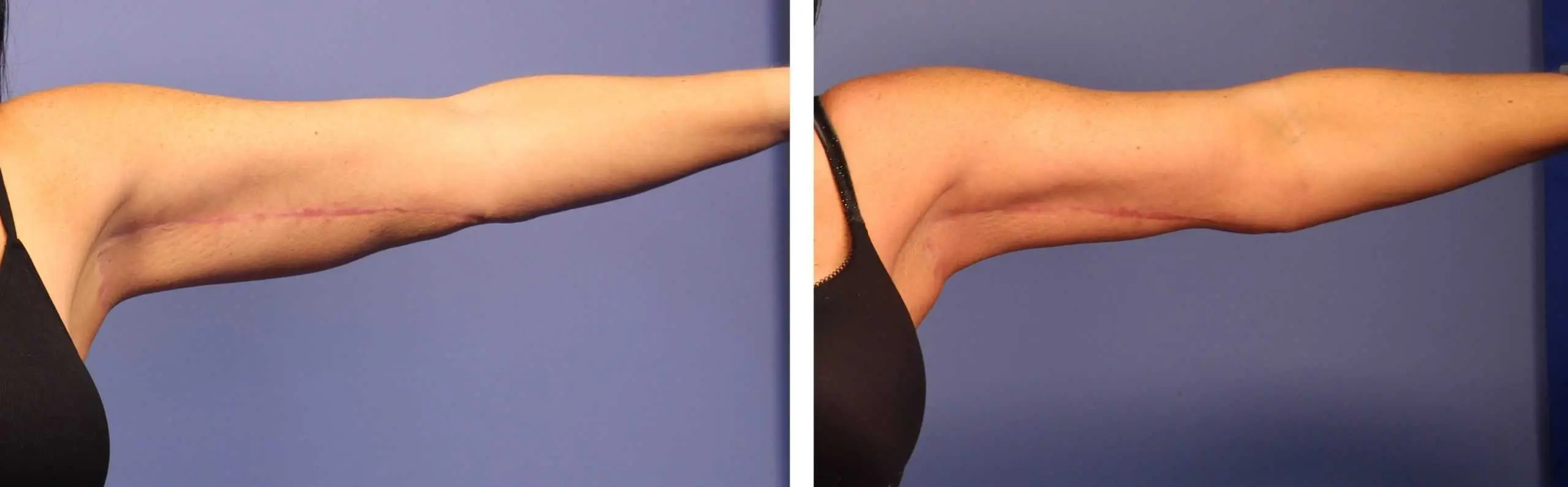 Coolsculpting Arms Before And After Results Sehat Nagar 1575