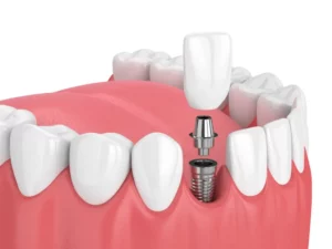 infection-around-dental-implant