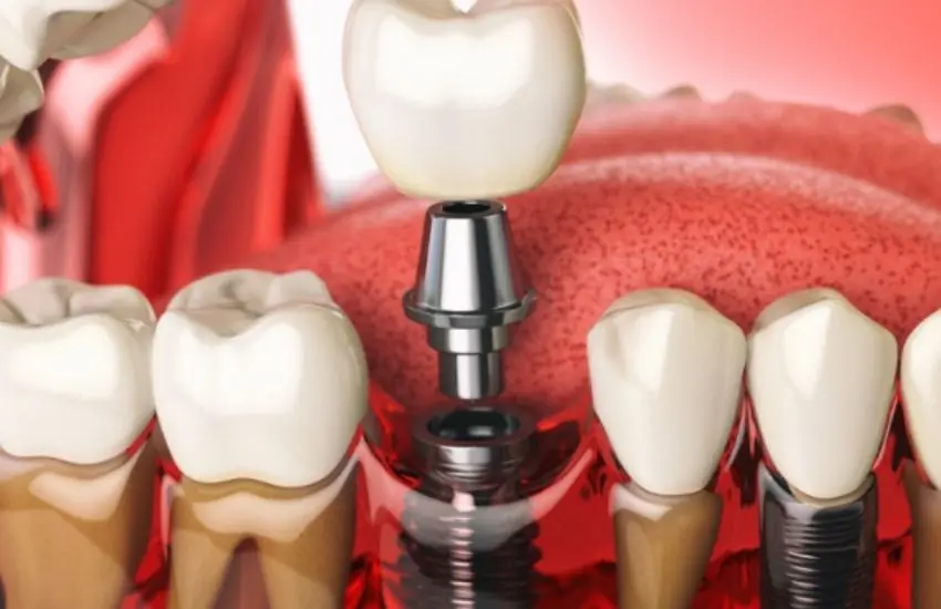infection-around-dental-implant-sehatnagar-com