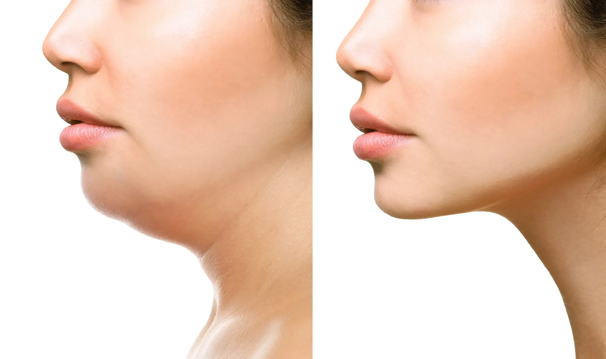 kybella-before-and-after-results