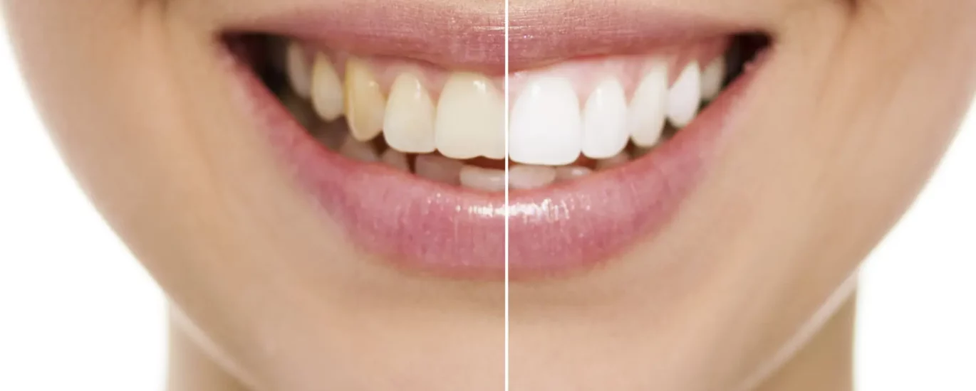 teeth-bonding-before-and-after-sehatnagar-com