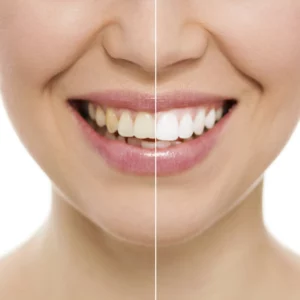 teeth-bonding-before-and-after-sehatnagar-com
