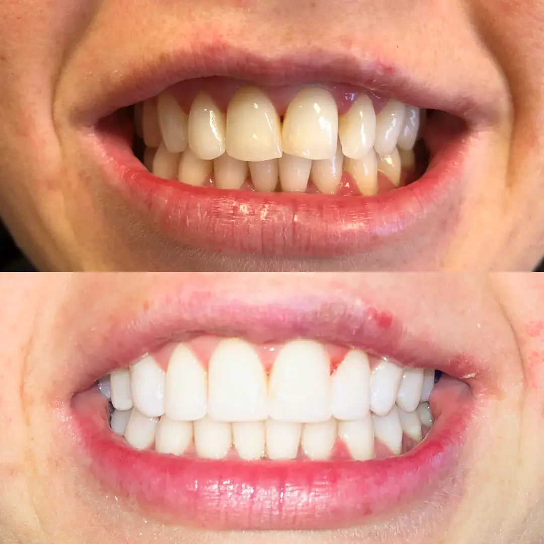 teeth-bonding-before-and-after-sehatnagar
