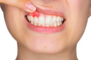 How Long Can You Keep Your Teeth with Periodontal Disease