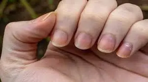 kidney disease nails