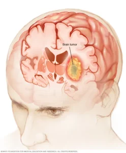 brain tumor survival rate