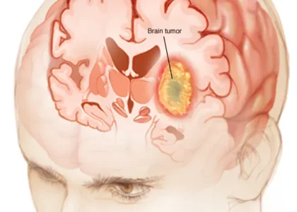brain tumor survival rate